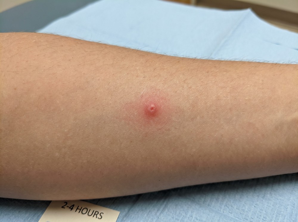 Close-up of a small faint red skin mark with no blistering or discoloration, illustrating how unremarkable a mild bite looks